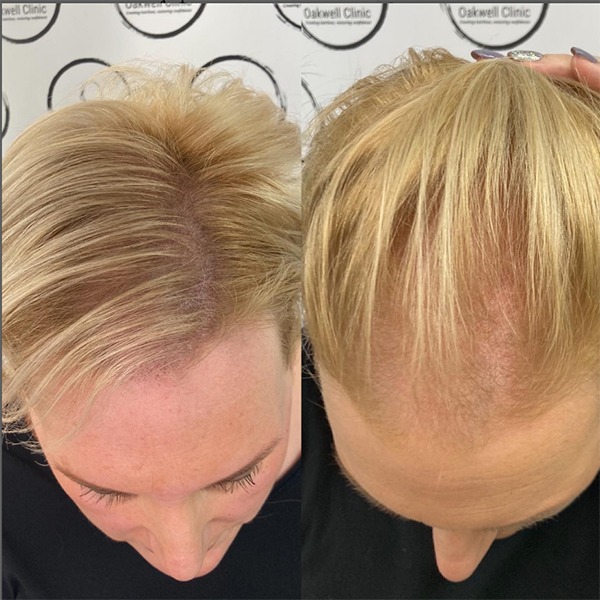 scalp micropigmentation women